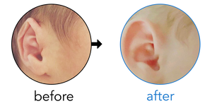 Before-and-after EarBuddies Folded-Over Helical Rim result; started within the first month – Jen Cavy