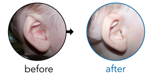 Before-and-after EarBuddies Cryptotia result; started at 6–12 months – Stephanie & her Son