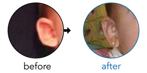 Before-and-after EarBuddies Stick-Out Ears result; started at 1–3 months – Mrs. Perez & her Daughter