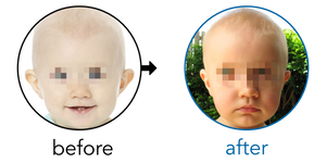 Before-and-after EarBuddies Stick-Out Ears result; started at 12–18 months – Mrs Tam J & her Daughter