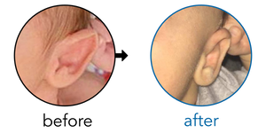 Before-and-after EarBuddies Stick-Out Ears result; started at 1–3 months – Mrs. Kasey O. & her Son