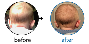 Before-and-after EarBuddies Stick-Out Ears result; started at 1–3 months – Mrs K.W & her Son Harry
