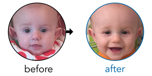 Before-and-after EarBuddies Stick-Out Ears result; started at 3–6 months – Michelle, Stuart & their Son Louis
