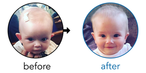 Before-and-after EarBuddies Stick-Out Ears result; started at 3–6 months – Laura & her Baby Daughter