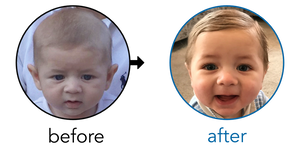 Before-and-after EarBuddies Stick-Out Ears result; started at 3–6 months – Danielle & her Son Jesse