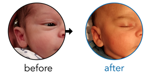 Before-and-after EarBuddies Stick-Out Ears result; started within the first month – David & his Son