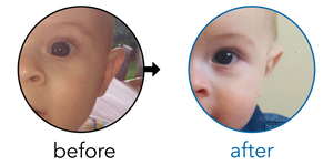 Before-and-after EarBuddies Stick-Out Ears result; started at 1–3 months – Amanda & her Son Harry