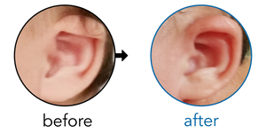 Before-and-after EarBuddies Lop Ear result; started at 1–3 months – Samantha & her Daughter Carter