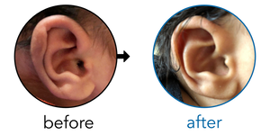 Before-and-after EarBuddies Folded-Over Helical Rim result; started within the first month – Gav & his Son Rivi