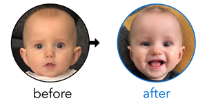 Before-and-after EarBuddies Stick-Out Ears result; started at 6–12 months – @ourearbuddiesjourney