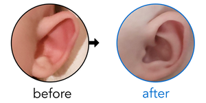 Before-and-after EarBuddies Stick-Out Ears result; started at 3–6 months – Nicole & her daughter Molly