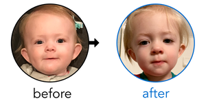 Before-and-after EarBuddies Stick-Out Ears result; started at 6–12 months – Ashley & her Daughter Kira
