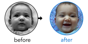 Before-and-after EarBuddies Stick-Out Ears result; started at 1–3 months – @earbuddies_journey