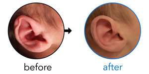 Before-and-after EarBuddies Rim Kink result; started within the first month – Lillian & her Son Evan
