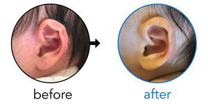 Before-and-after EarBuddies Rim Kink result; started within the first month – Masako & her Daughter Emma