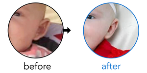 Before-and-after EarBuddies Stick-Out Ears result; started at 3–6 months – Amanda D