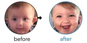 Before-and-after EarBuddies Stick-Out Ears result; started at 3–6 months – Simone S