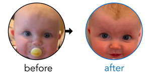 Before-and-after EarBuddies Cup Ear result; started at 1–3 months – Stephanie & her Daughter Ferne