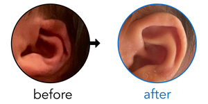 Before-and-after EarBuddies Folded-Over Helical Rim result; started within the first month – Kelsey & her Son