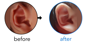 Before-and-after EarBuddies Rim Kink result; started within the first month – Rafaela & her Son
