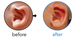 Before-and-after EarBuddies Rim Kink result; started at 3–6 months – Gabriela & her son