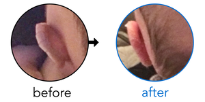 Before-and-after EarBuddies Lop Ear result; started at 1–3 months – Kat & her son Luke