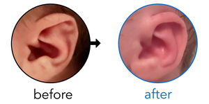 Before-and-after EarBuddies Stahl's Bar result; started at 1–3 months – Laurel & her baby