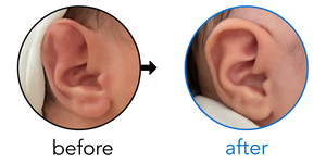 Before-and-after EarBuddies Stahl's Bar result; started at 1–3 months – Diana & her daughter