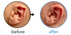 Before-and-after EarBuddies Folded-Over Helical Rim result; started within the first month – Artur & his son Kai