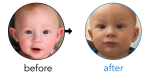 Before-and-after EarBuddies Stick-Out Ears result; started at 3–6 months – Elena, James & their Son Alessandro