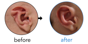 Before-and-after EarBuddies Stahl's Bar result; started within the first month – Brandi, Kirk & their son Griffin