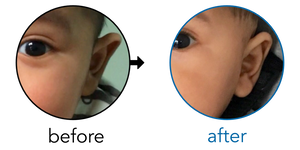 Before-and-after EarBuddies Stick-Out Ears result; started at 3–6 months – Abegail & her Son