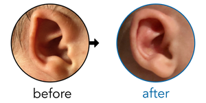 Before-and-after EarBuddies Folded-Over Helical Rim result; started at 1–3 months – Dani & her son Cody