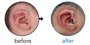 Before-and-after EarBuddies Lop Ear result; started within the first month – Boian, Natalie & Baby Gala