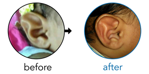 Before-and-after EarBuddies Stahl's Bar result; started at 1–3 months – Sarvesh, Kinari & their Daughter Nandika