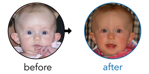 Before-and-after EarBuddies Stick-Out Ears result; started at 3–6 months – Christy & her Daughter
