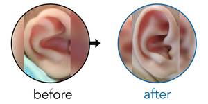 Before-and-after EarBuddies Stahl's Bar result; started at 1–3 months – Erica & her Daughter