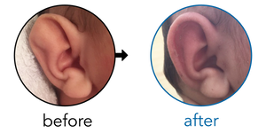 Before-and-after EarBuddies Stahl's Bar result; started at 1–3 months – Denise & her Daughter