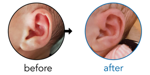 Before-and-after EarBuddies Rim Kink result; started at 1–3 months – Ibrahim & his Daughter Miray
