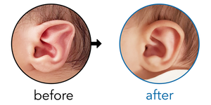 Before-and-after EarBuddies Stahl's Bar result; started within the first month – Emel & his Son
