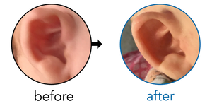 Before-and-after EarBuddies Stahl's Bar result; started at 1–3 months – Nicola & her Son