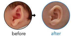 Before-and-after EarBuddies Stick-Out Lobe result; started at 1–3 months – Kristina & her son Aron