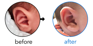 Before-and-after EarBuddies Conchal Crus result; started within the first month – Georgette & her son Alexis
