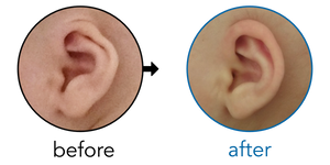 Before-and-after EarBuddies Cryptotia result; started at 1–3 months – Sebastian & his son