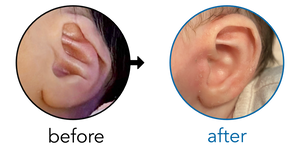 Before-and-after EarBuddies Conchal Crus result; started within the first month – Alyssa & her daughter
