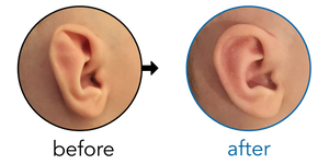 Before-and-after EarBuddies Stahl's Bar result; started at 1–3 months – Erin & her Son Augie