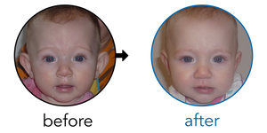 Before-and-after EarBuddies Stick-Out Ears result; started at 3–6 months – Julie and her Daughter