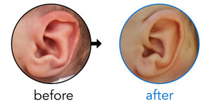 Before-and-after EarBuddies Stahl's Bar result; started at 1–3 months – Kylee & her Son