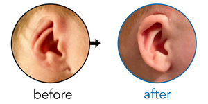 Before-and-after EarBuddies Cryptotia result; started at 1–3 months – Charlotte & her son