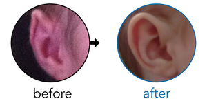 Before-and-after EarBuddies Folded-Over Helical Rim result; started within the first month – Laura & her Son Beck